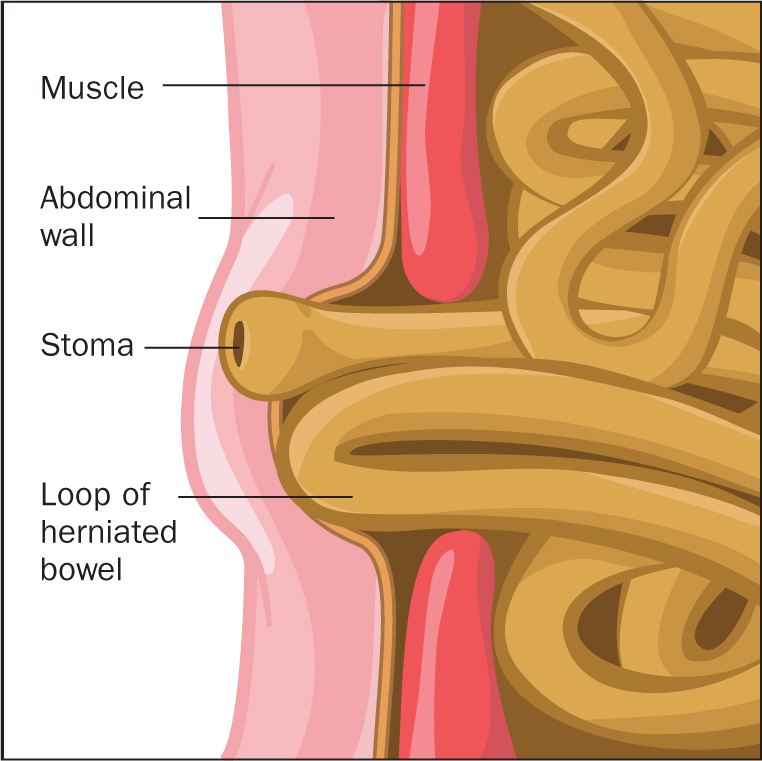 Cross-section diagram showing the abdominal wall, muscle, stoma, and a loop of herniated bowel
