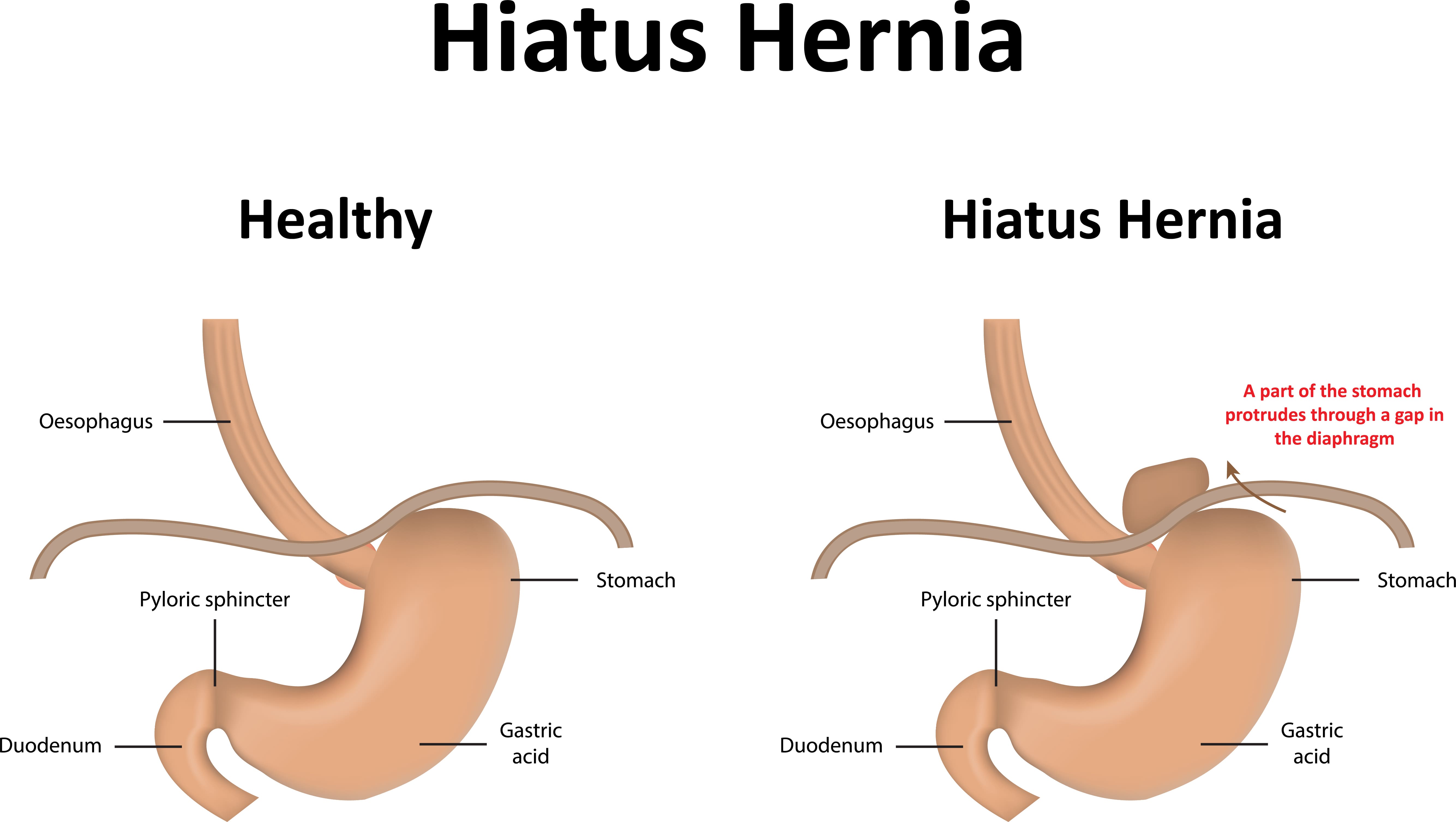 What Size Hiatal Hernia Needs Surgery