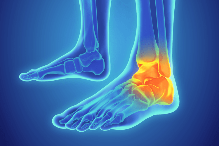 Ankle traumas are common — learn how to take an ankle for support to prevent it