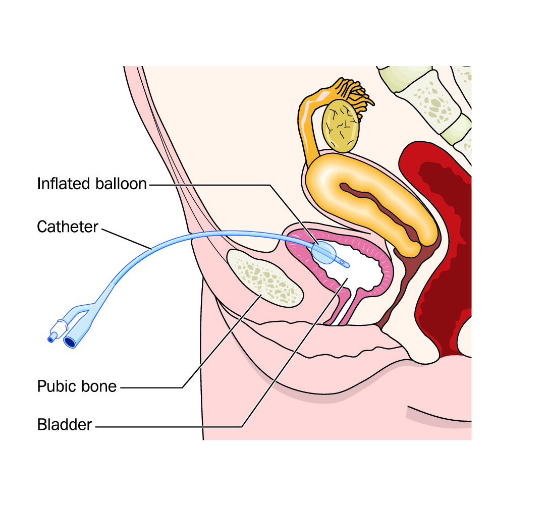 how to insert a catheter female patient