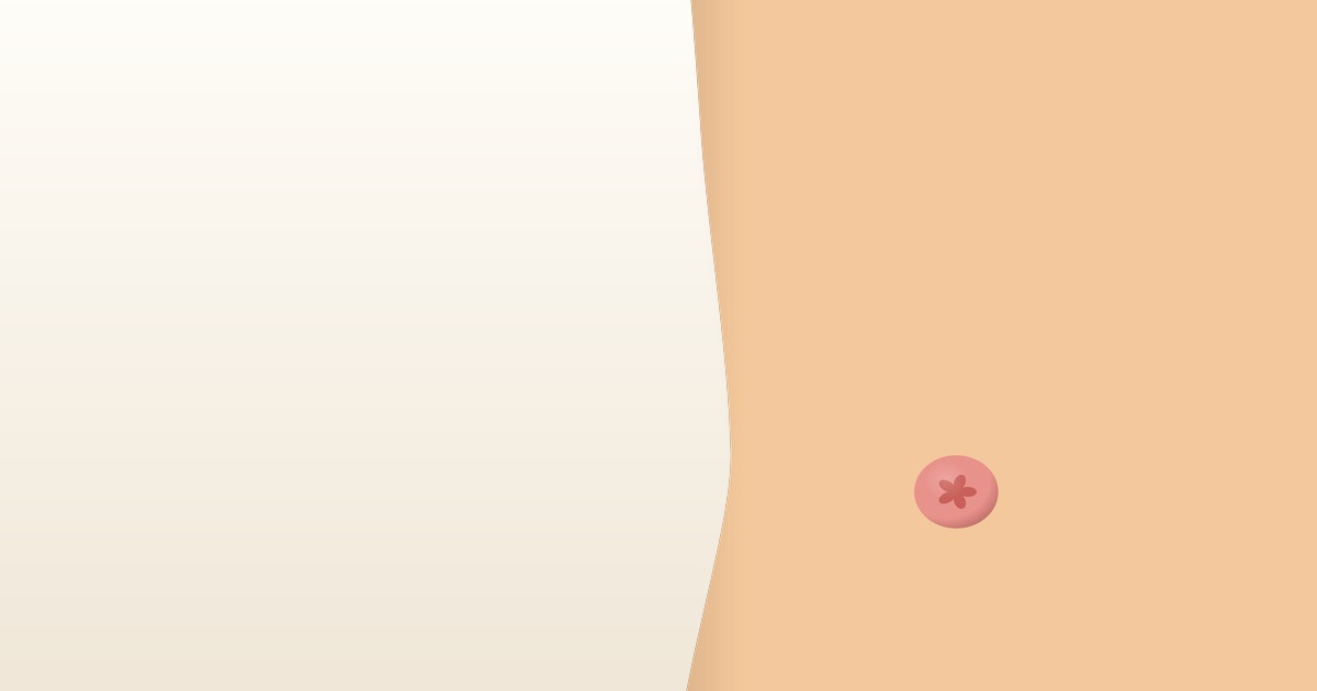 Peristomal Skin Health: Keeping the Skin Around Your Stoma Healthy