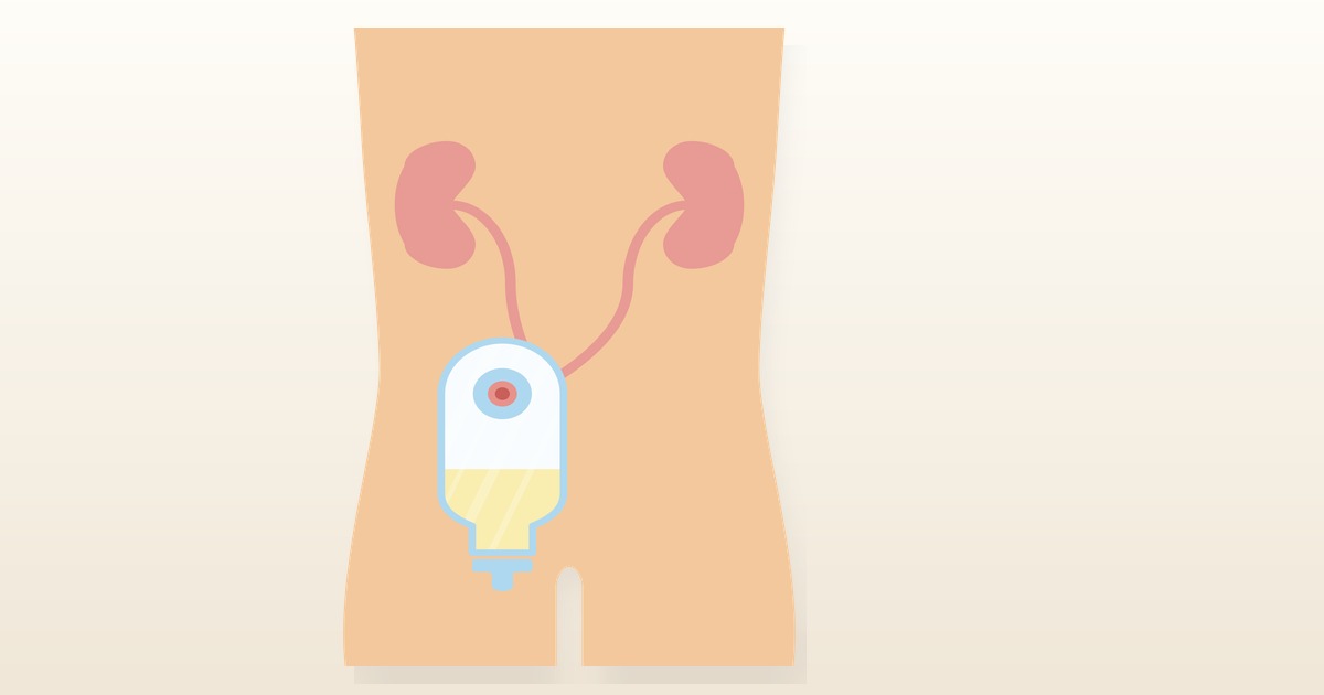 Basic Urostomy Care: A Guide to Stoma & Pouch Management